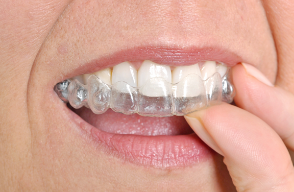 How To Make Your Invisalign Treatment Quick And Easy In North Fair Oaks Ca